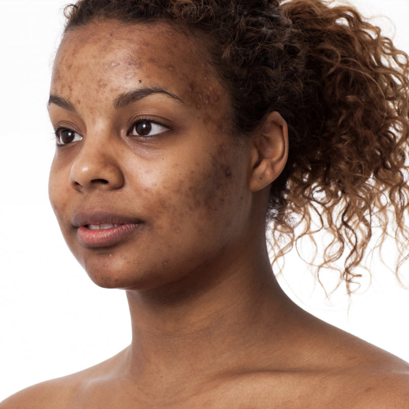 Hyperpigmentation and Dark Spots – How to Unify Your Complexion
